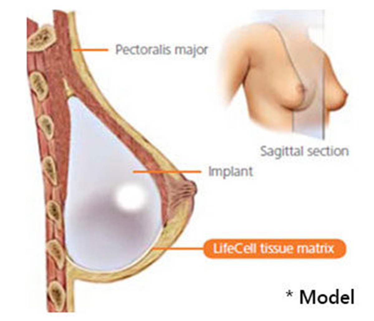 Strattice breast, Dennis Dass, MD in Beverly Hills