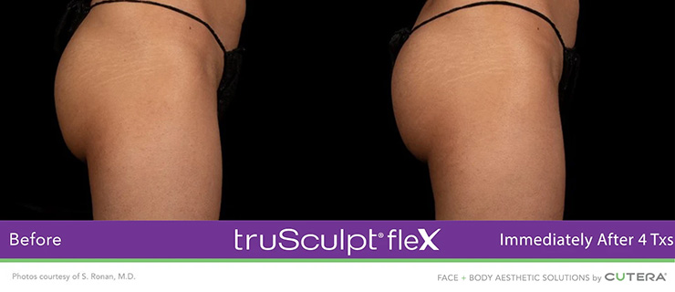 Dr Dennis Dass, TruSculpt Flex Before and After Image 1