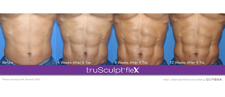 Dr Dennis Dass, TruSculpt Flex Before and After Image 4
